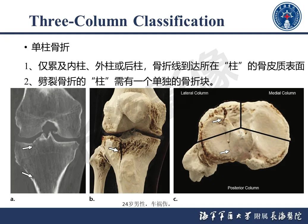 影像PPT - 【PPT】胫骨平台骨折三柱理论：骨科医生想知道什么-15