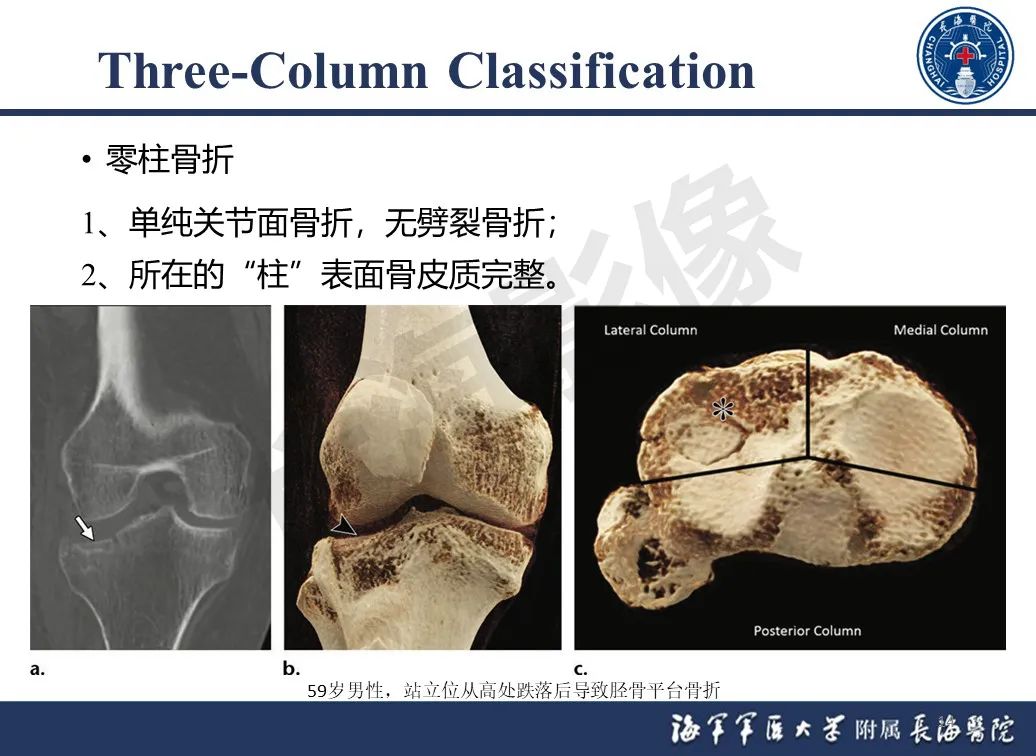 影像PPT - 【PPT】胫骨平台骨折三柱理论：骨科医生想知道什么-14
