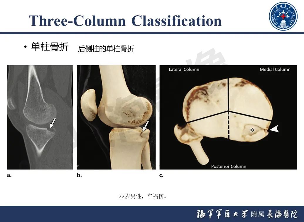 影像PPT - 【PPT】胫骨平台骨折三柱理论：骨科医生想知道什么-16