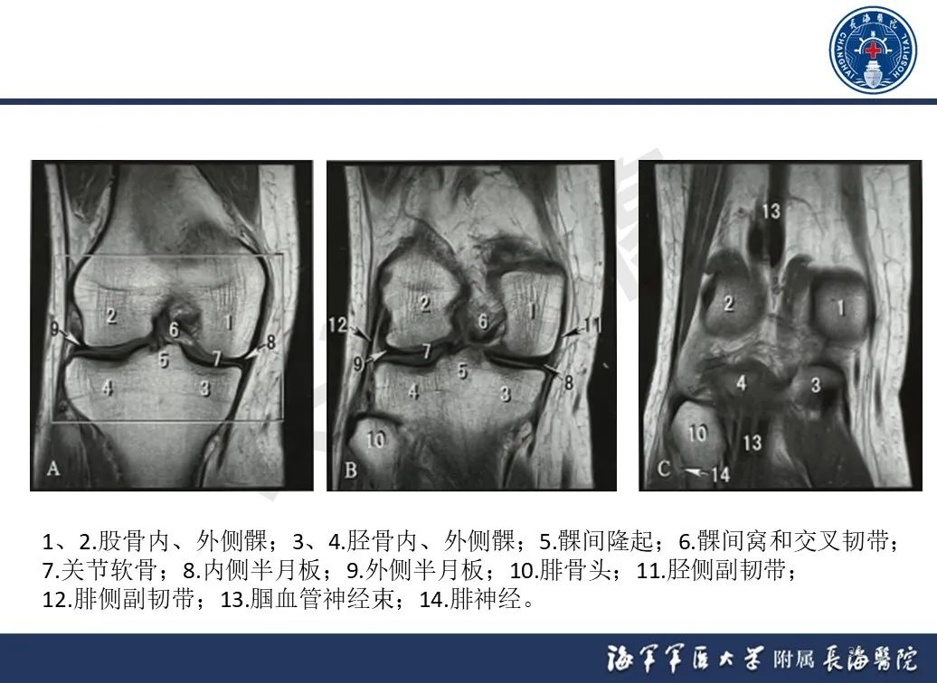 影像PPT - 【PPT】胫骨平台骨折三柱理论：骨科医生想知道什么-31