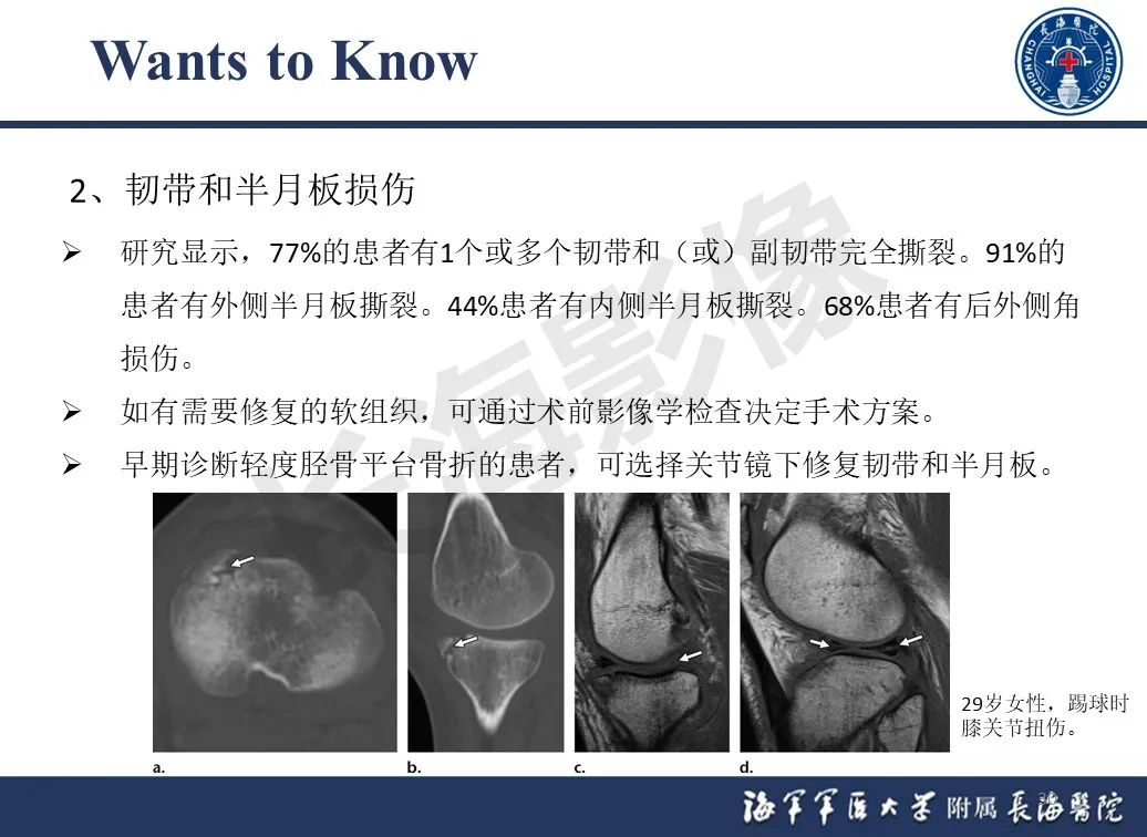 影像PPT - 【PPT】胫骨平台骨折三柱理论：骨科医生想知道什么-30