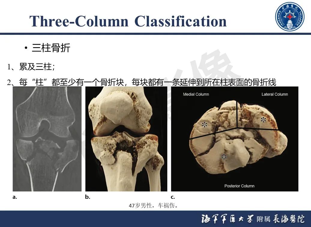 影像PPT - 【PPT】胫骨平台骨折三柱理论：骨科医生想知道什么-18