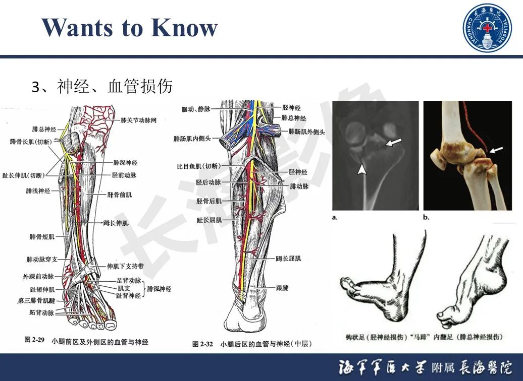 影像PPT - 【PPT】胫骨平台骨折三柱理论：骨科医生想知道什么-34