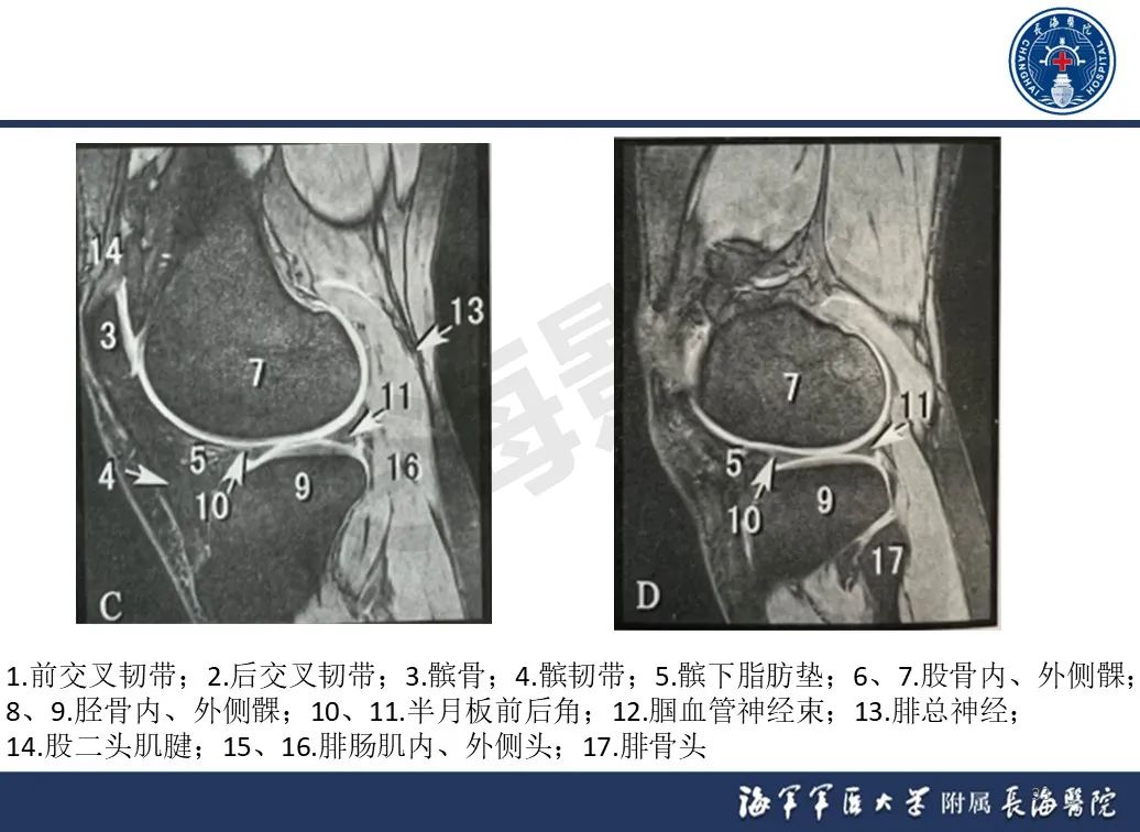 影像PPT - 【PPT】胫骨平台骨折三柱理论：骨科医生想知道什么-33