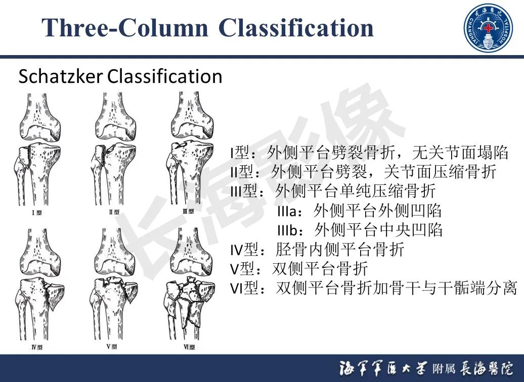影像PPT - 【PPT】胫骨平台骨折三柱理论：骨科医生想知道什么-19