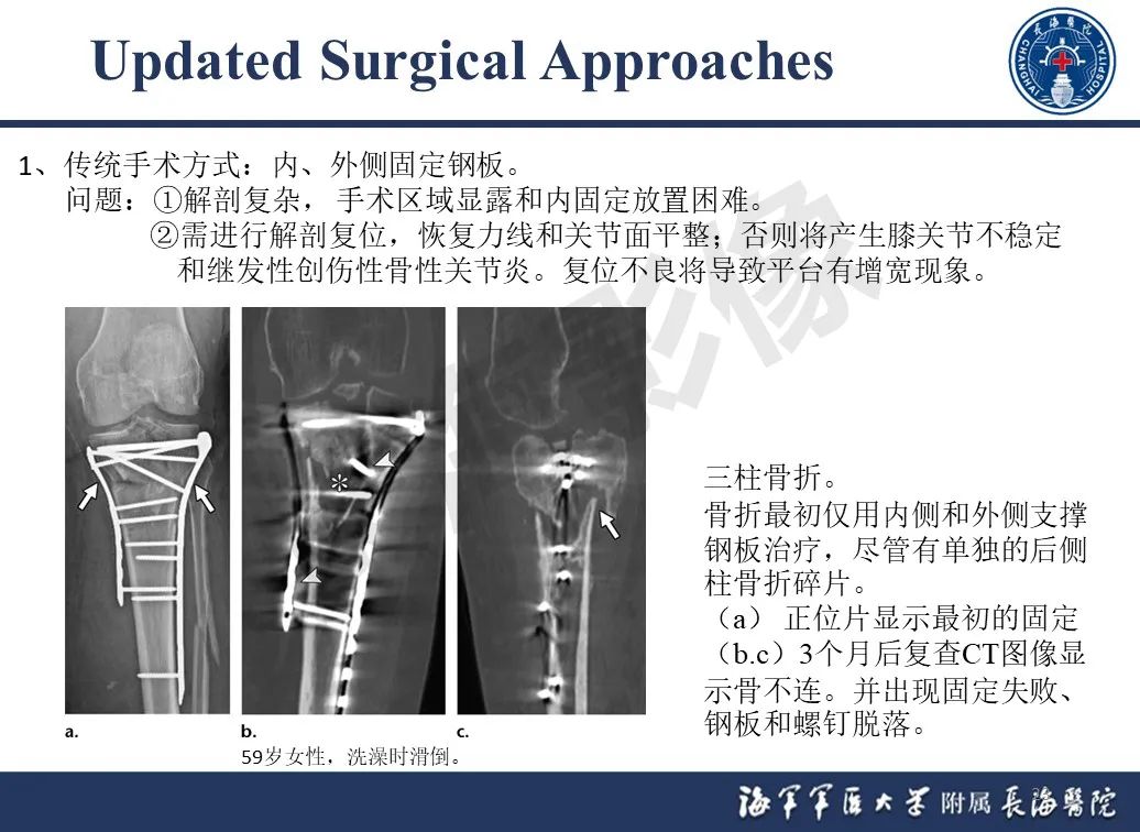 影像PPT - 【PPT】胫骨平台骨折三柱理论：骨科医生想知道什么-23