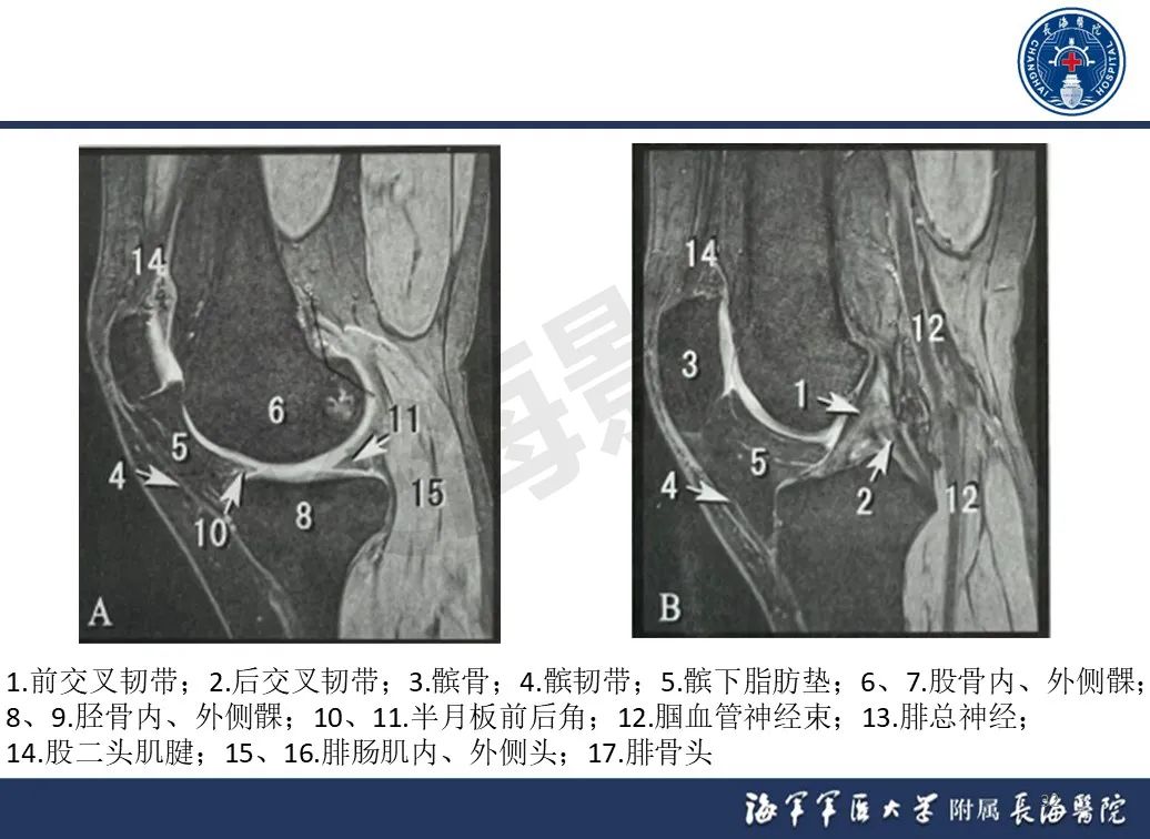 影像PPT - 【PPT】胫骨平台骨折三柱理论：骨科医生想知道什么-32