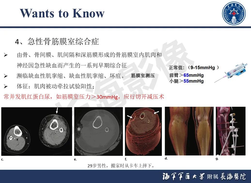 影像PPT - 【PPT】胫骨平台骨折三柱理论：骨科医生想知道什么-35