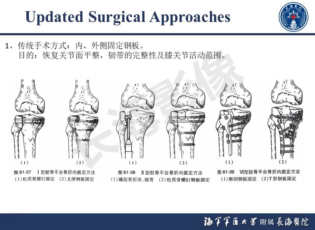 影像PPT - 【PPT】胫骨平台骨折三柱理论：骨科医生想知道什么-22