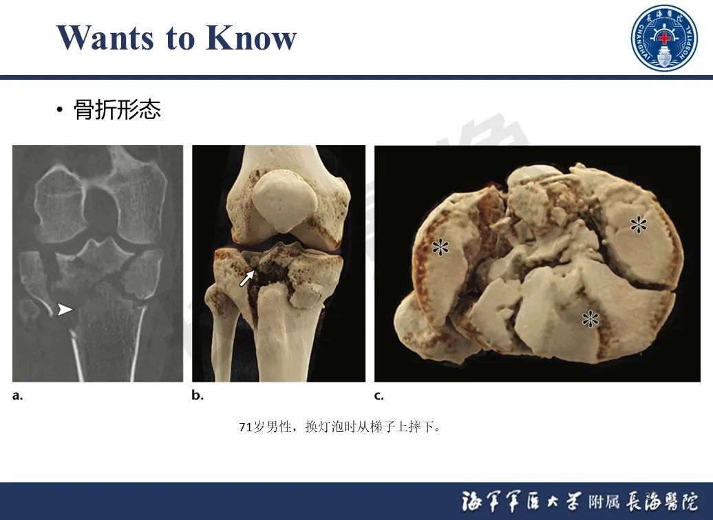 影像PPT - 【PPT】胫骨平台骨折三柱理论：骨科医生想知道什么-27