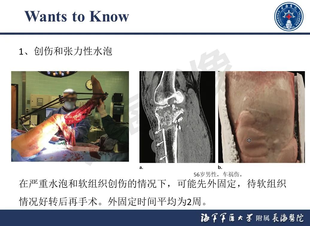 影像PPT - 【PPT】胫骨平台骨折三柱理论：骨科医生想知道什么-1