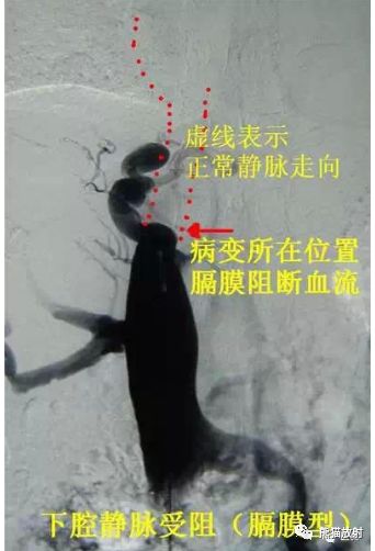 影像PPT - 布加氏综合征肝脏继发改变MRI表现-4 影像PPT - 布加氏综合征肝脏继发改变MRI表现-4