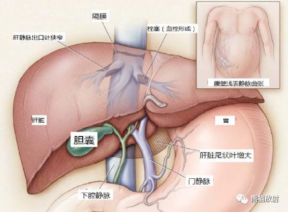 影像PPT - 布加氏综合征肝脏继发改变MRI表现-1 影像PPT - 布加氏综合征肝脏继发改变MRI表现-1