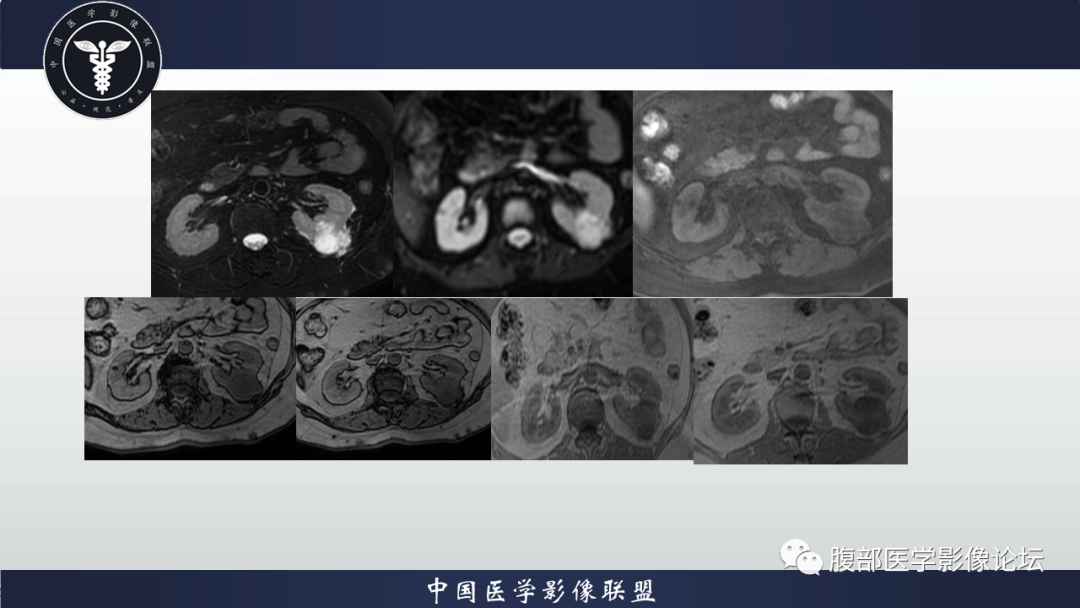 影像PPT - 【病例】肾脏嗜酸细胞瘤1例MR影像-3