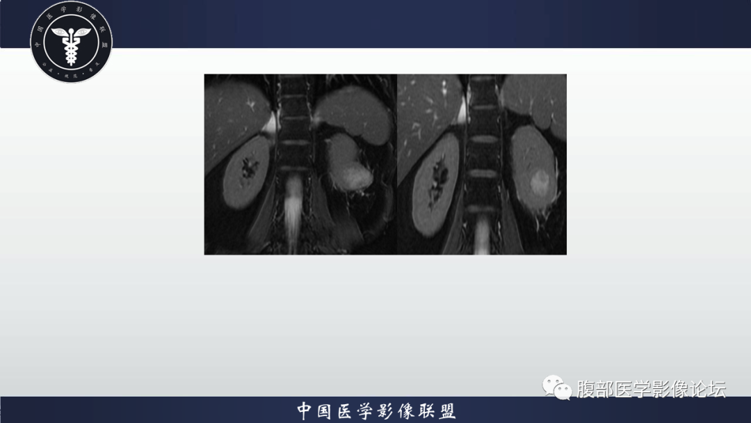 影像PPT - 【病例】肾脏嗜酸细胞瘤1例MR影像-4