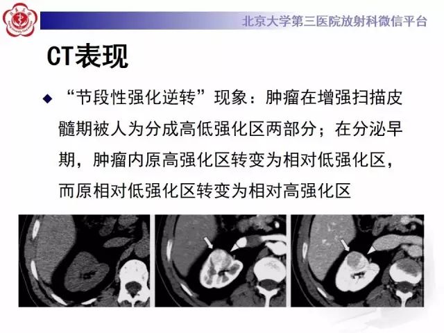 影像PPT - 【病例】肾脏嗜酸细胞瘤1例MR影像-13