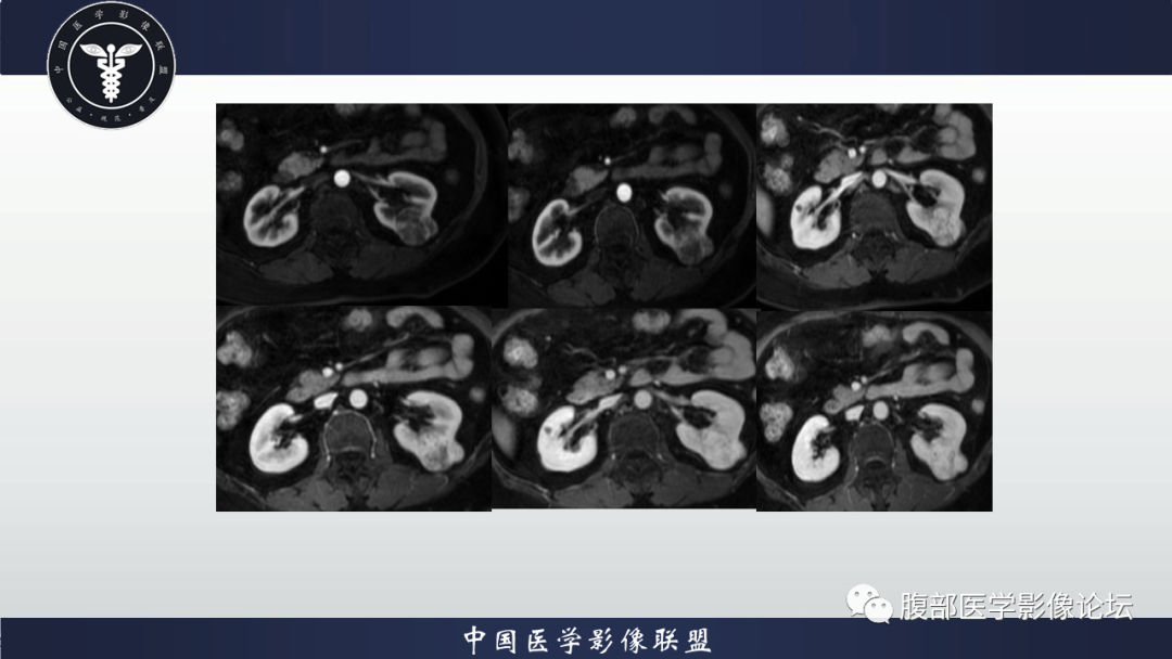 影像PPT - 【病例】肾脏嗜酸细胞瘤1例MR影像-5