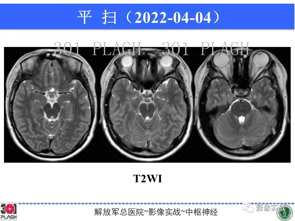 影像PPT - 【病例】鞍区生殖细胞瘤1例MR影像-11