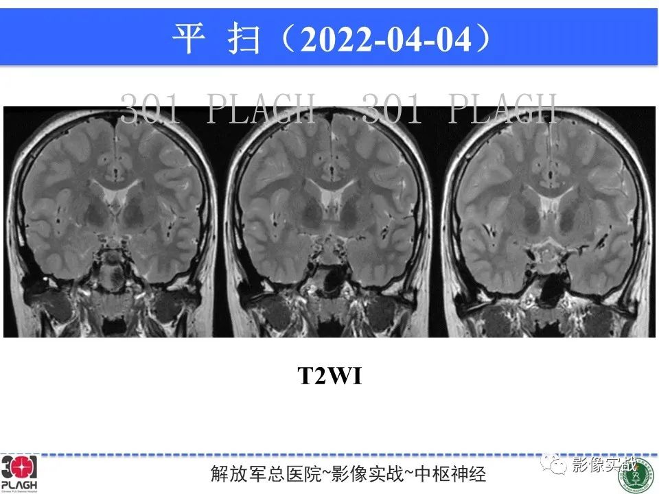 影像PPT - 【病例】鞍区生殖细胞瘤1例MR影像-12
