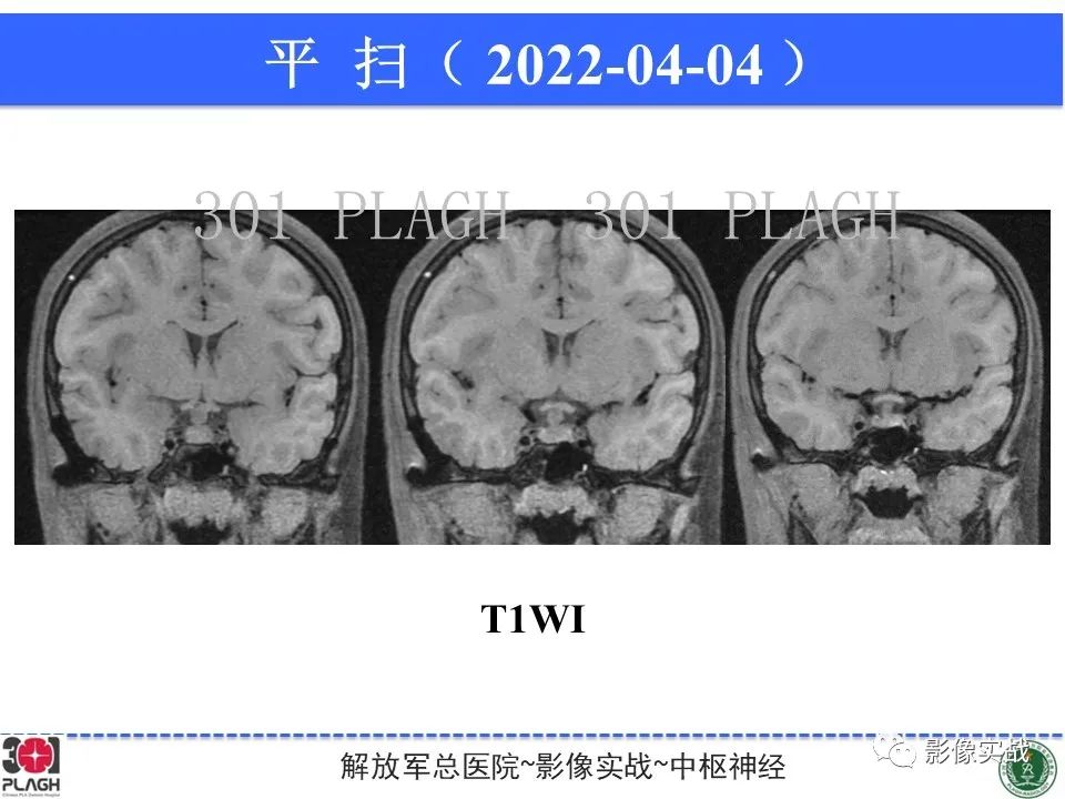 影像PPT - 【病例】鞍区生殖细胞瘤1例MR影像-14
