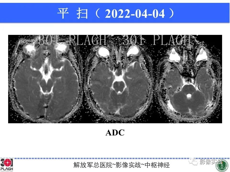 影像PPT - 【病例】鞍区生殖细胞瘤1例MR影像-16