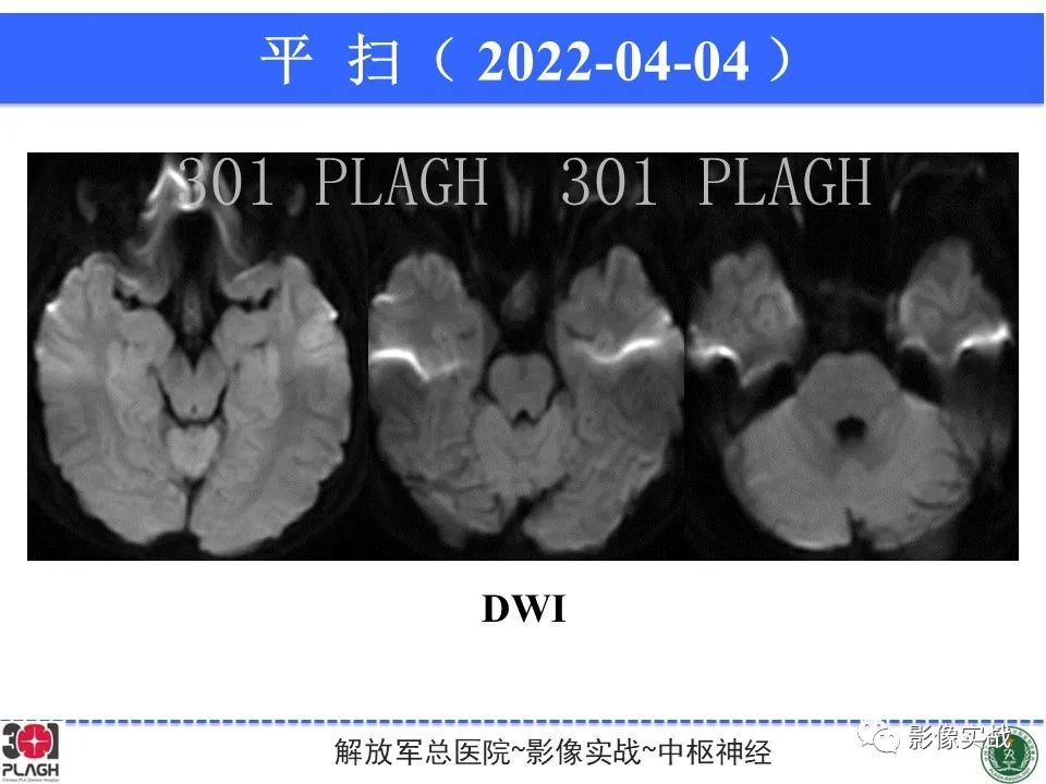 影像PPT - 【病例】鞍区生殖细胞瘤1例MR影像-15