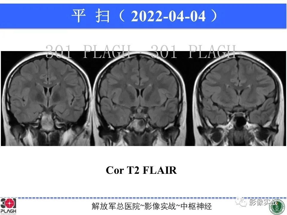 影像PPT - 【病例】鞍区生殖细胞瘤1例MR影像-17