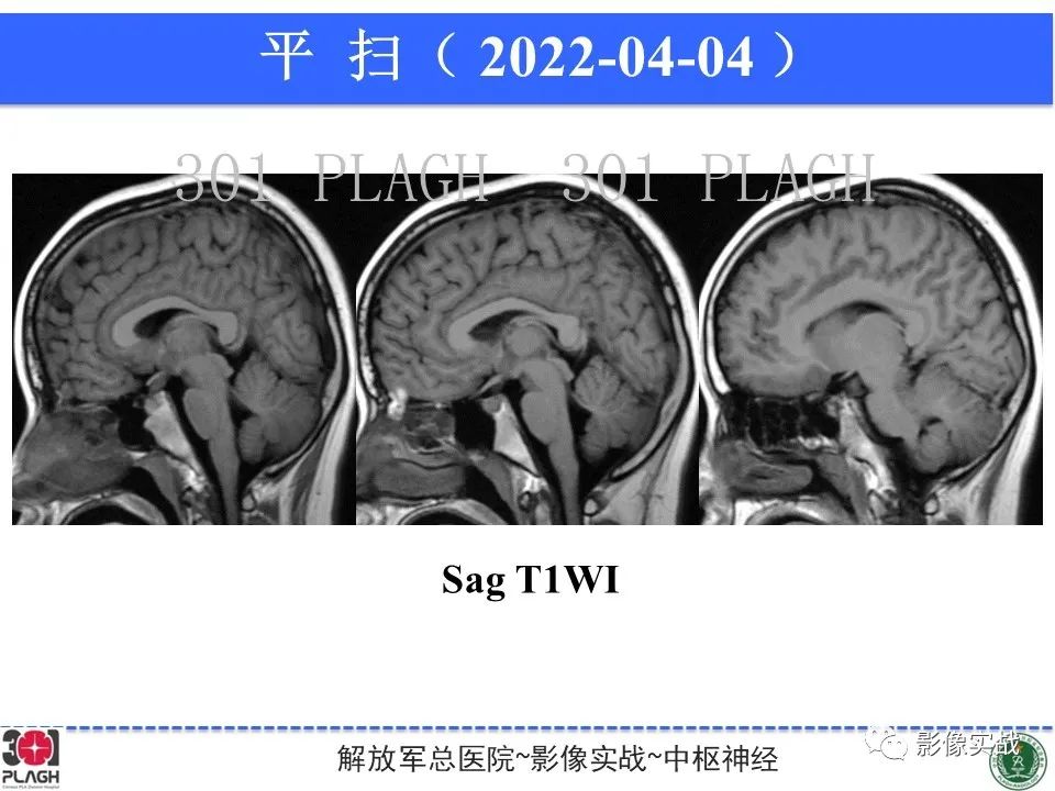 影像PPT - 【病例】鞍区生殖细胞瘤1例MR影像-18