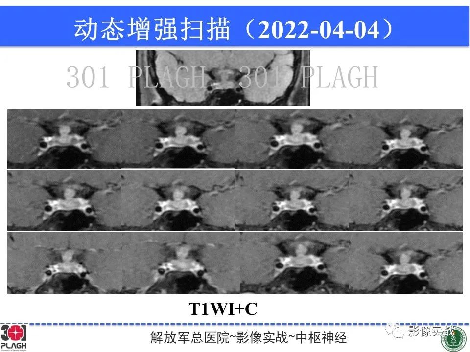 影像PPT - 【病例】鞍区生殖细胞瘤1例MR影像-19