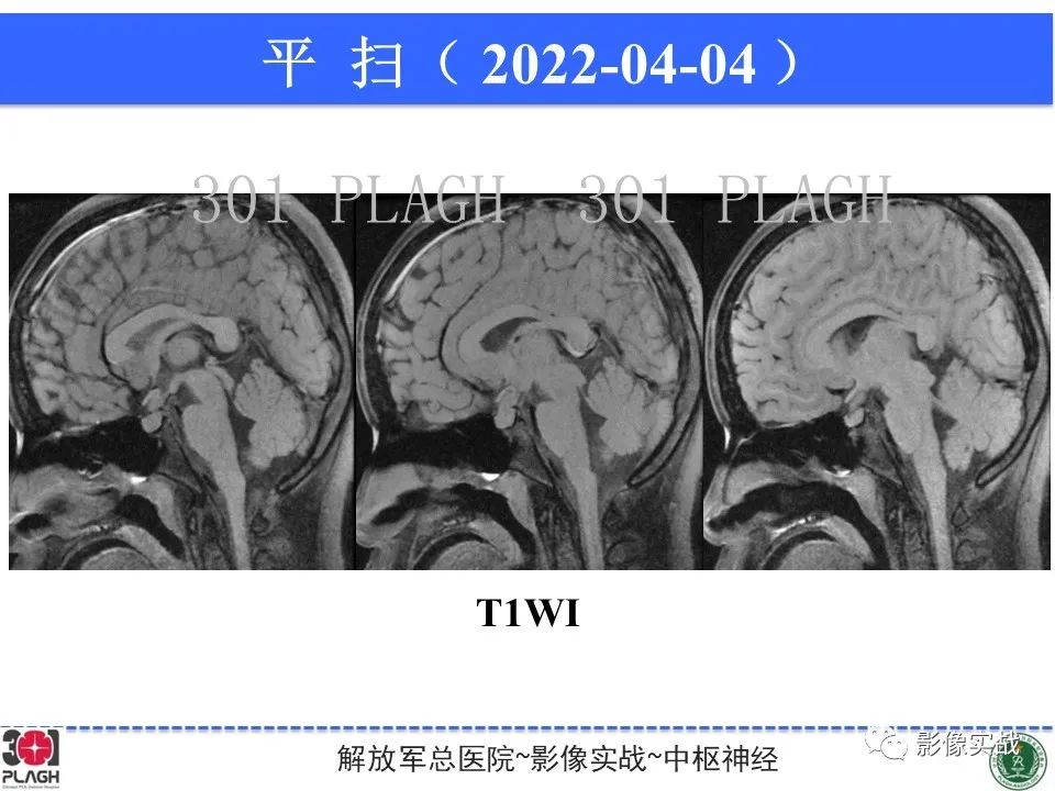 影像PPT - 【病例】鞍区生殖细胞瘤1例MR影像-13