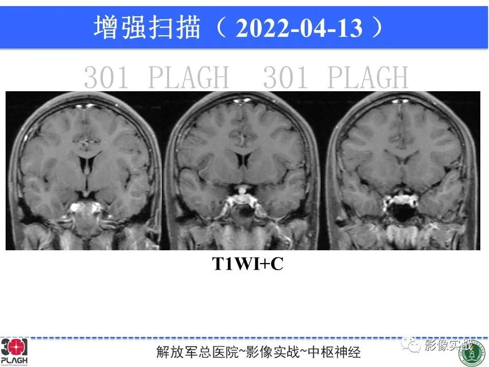 影像PPT - 【病例】鞍区生殖细胞瘤1例MR影像-21