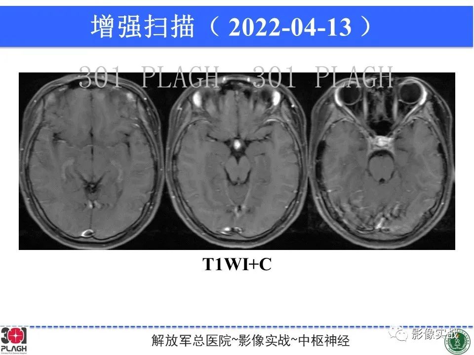影像PPT - 【病例】鞍区生殖细胞瘤1例MR影像-20