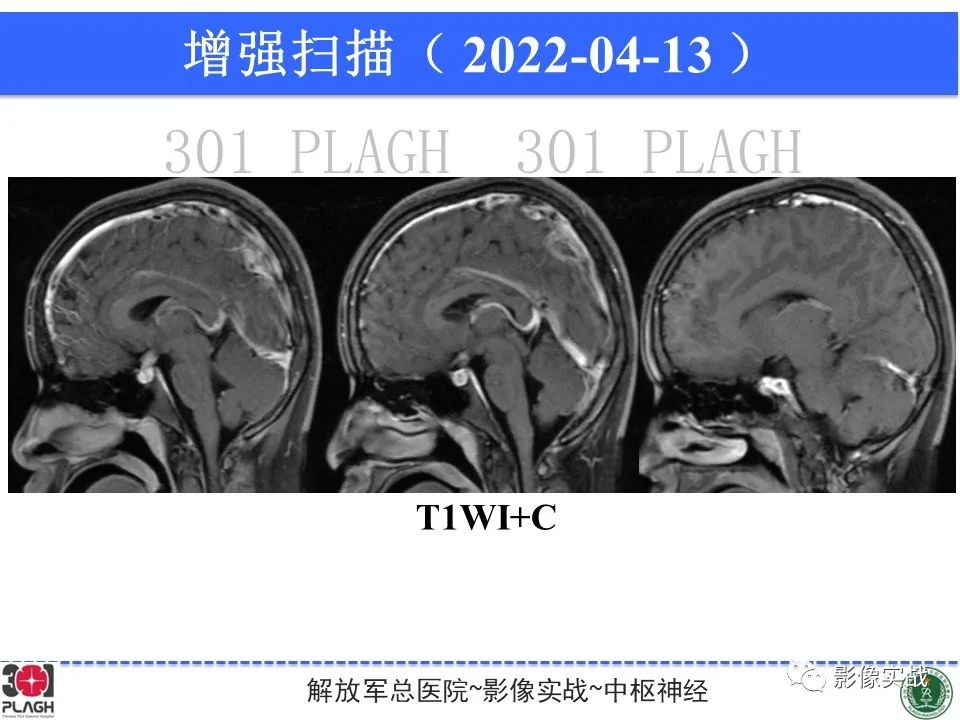 影像PPT - 【病例】鞍区生殖细胞瘤1例MR影像-22