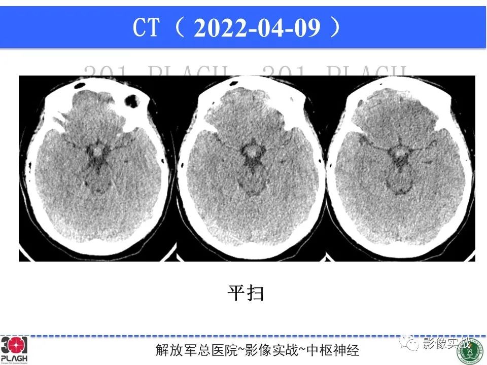 影像PPT - 【病例】鞍区生殖细胞瘤1例MR影像-23