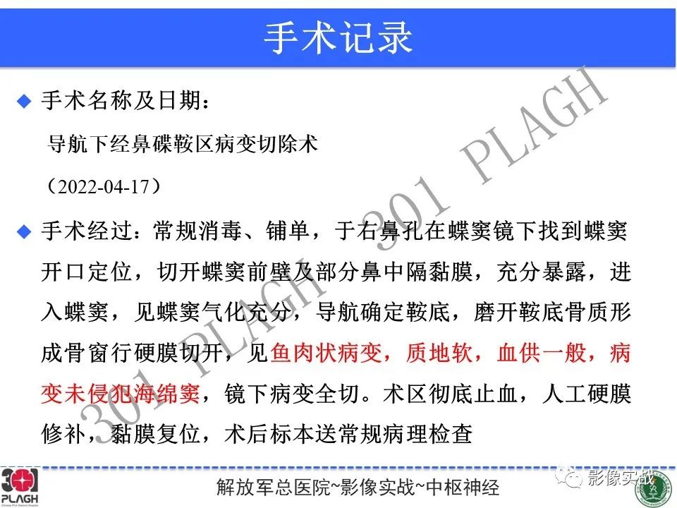 影像PPT - 【病例】鞍区生殖细胞瘤1例MR影像-30