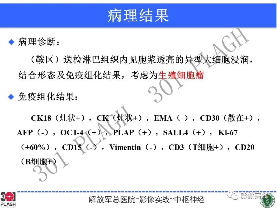 影像PPT - 【病例】鞍区生殖细胞瘤1例MR影像-31