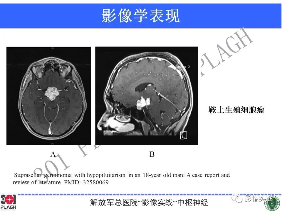影像PPT - 【病例】鞍区生殖细胞瘤1例MR影像-35