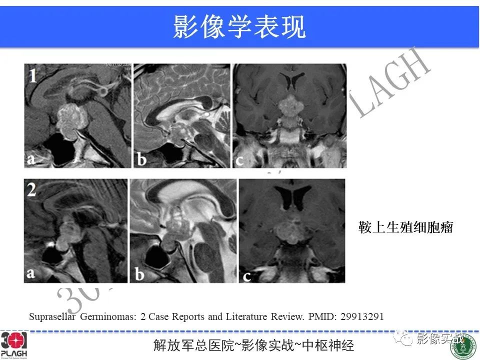 影像PPT - 【病例】鞍区生殖细胞瘤1例MR影像-36