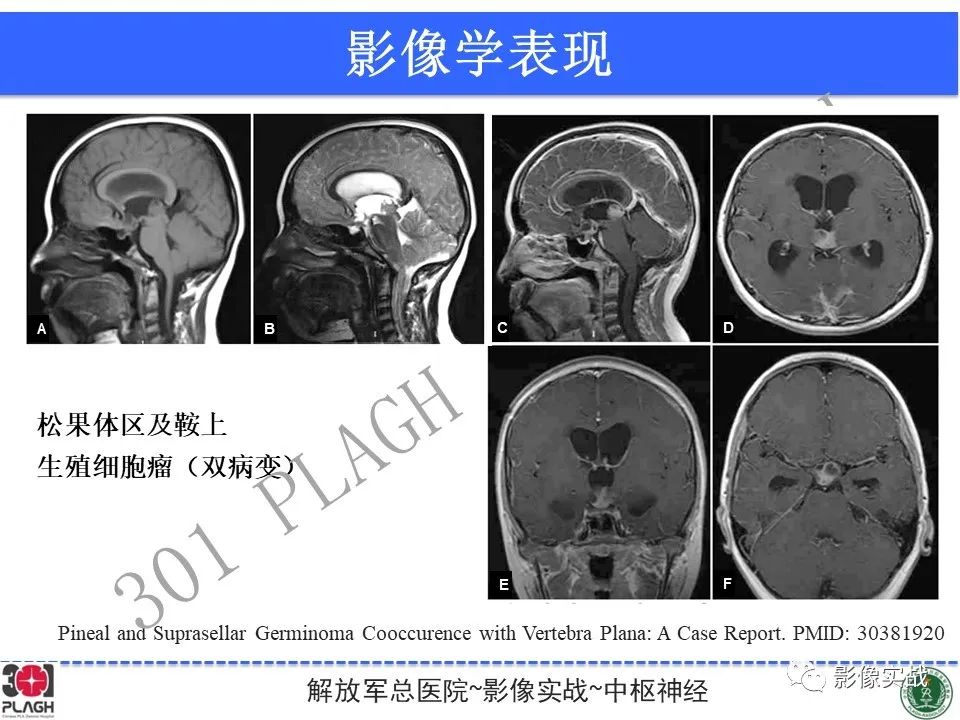 影像PPT - 【病例】鞍区生殖细胞瘤1例MR影像-37
