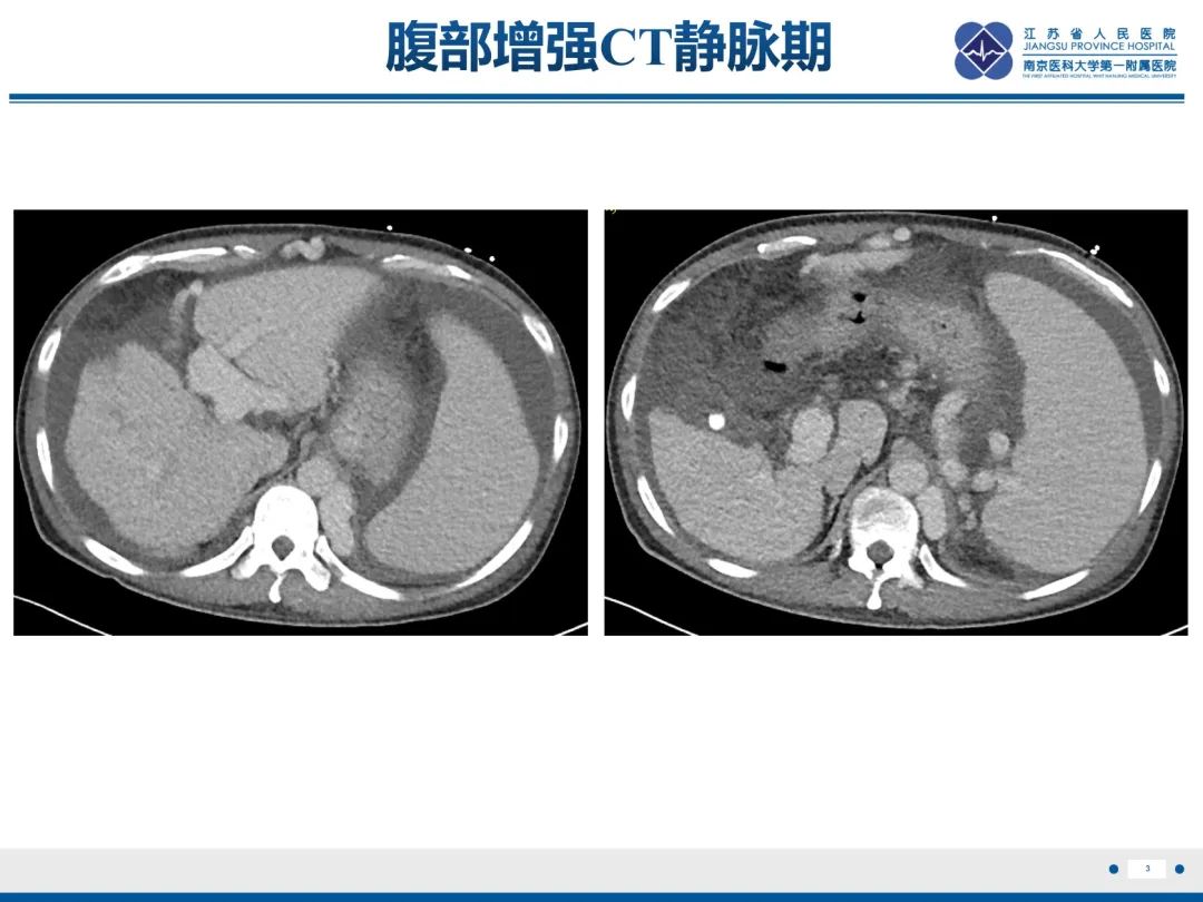 影像PPT - 【PPT】隐球菌脑膜脑炎-4