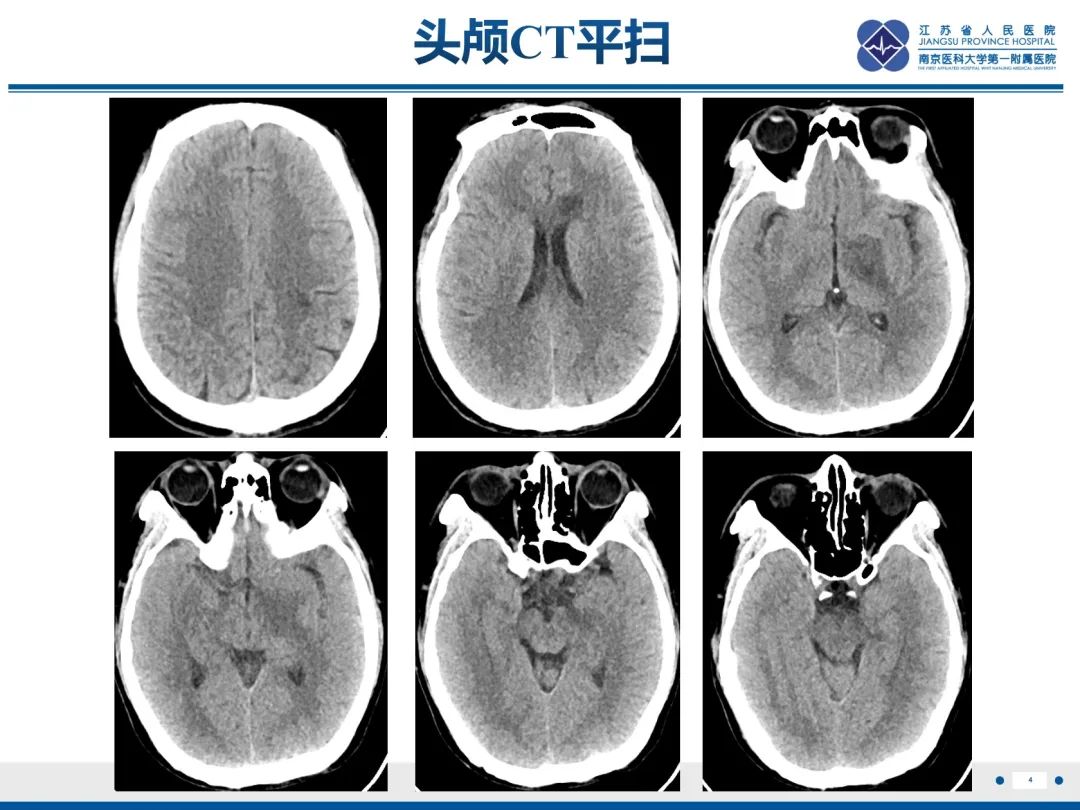 影像PPT - 【PPT】隐球菌脑膜脑炎-5