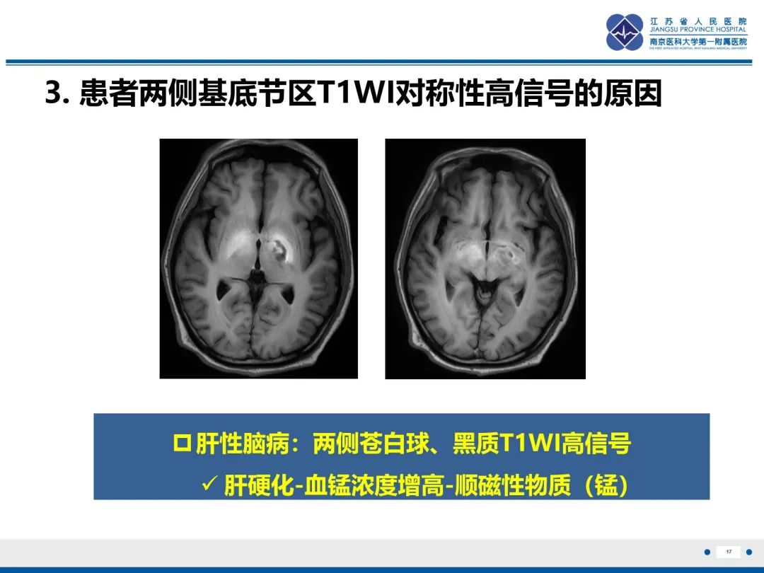 影像PPT - 【PPT】隐球菌脑膜脑炎-18