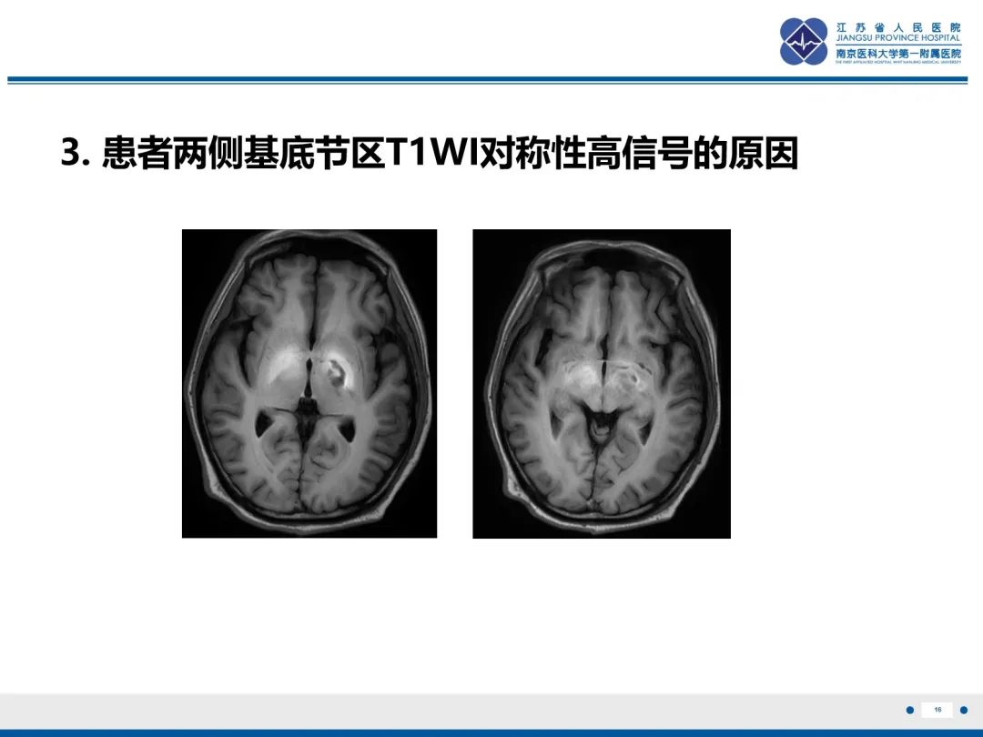 影像PPT - 【PPT】隐球菌脑膜脑炎-17