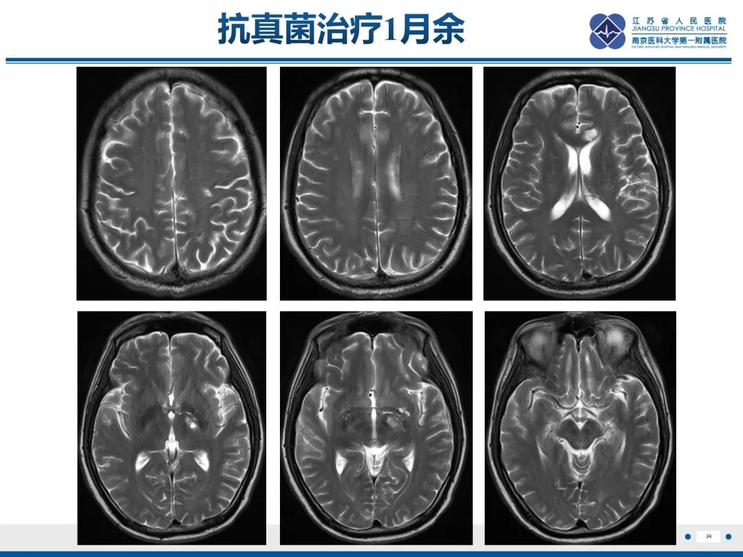 影像PPT - 【PPT】隐球菌脑膜脑炎-25
