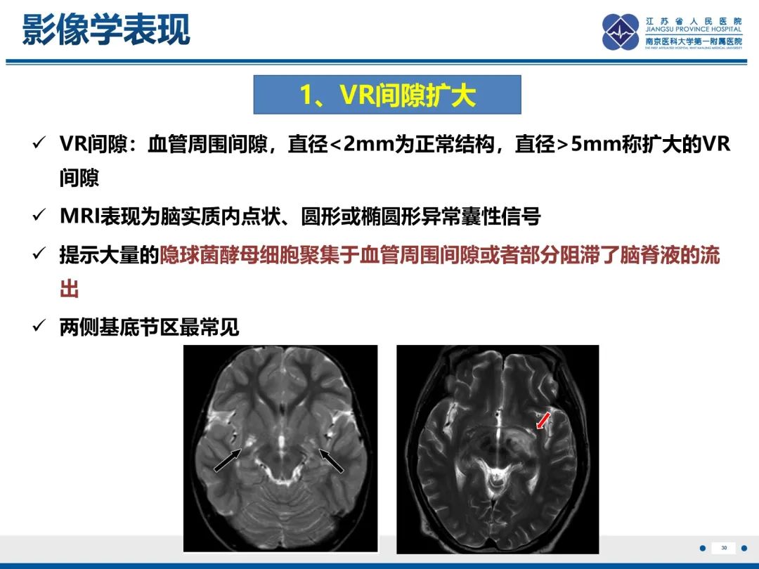 影像PPT - 【PPT】隐球菌脑膜脑炎-31