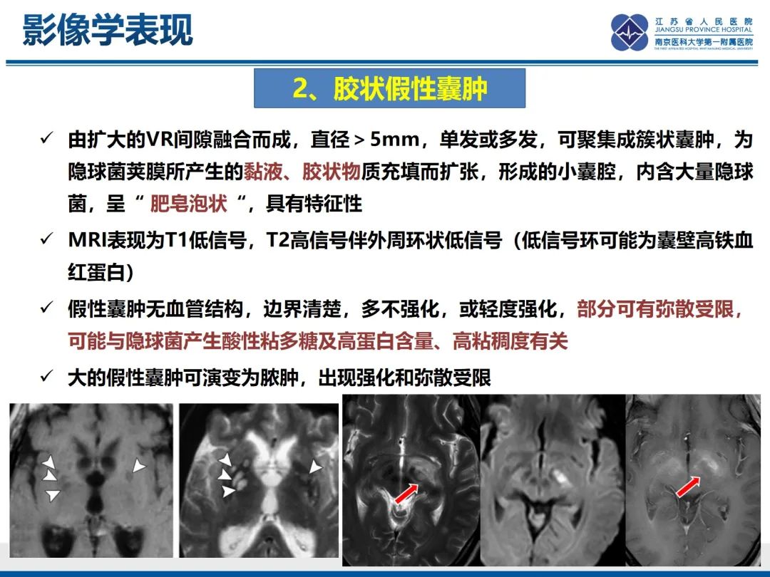 影像PPT - 【PPT】隐球菌脑膜脑炎-32