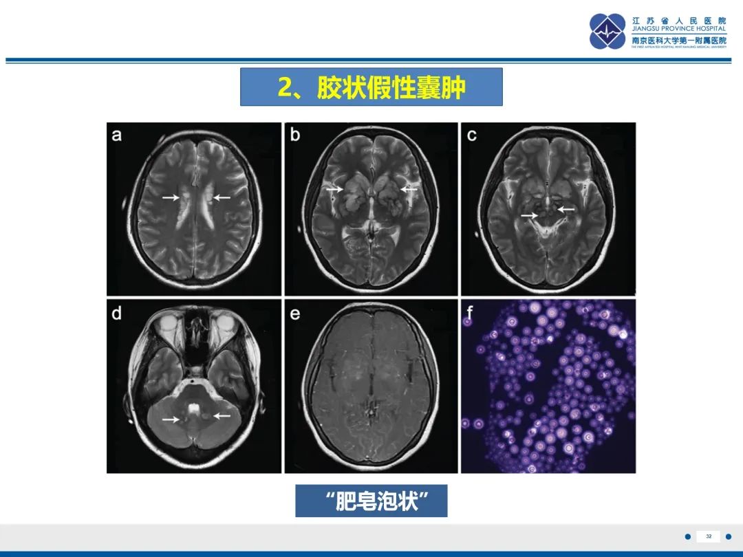 影像PPT - 【PPT】隐球菌脑膜脑炎-33