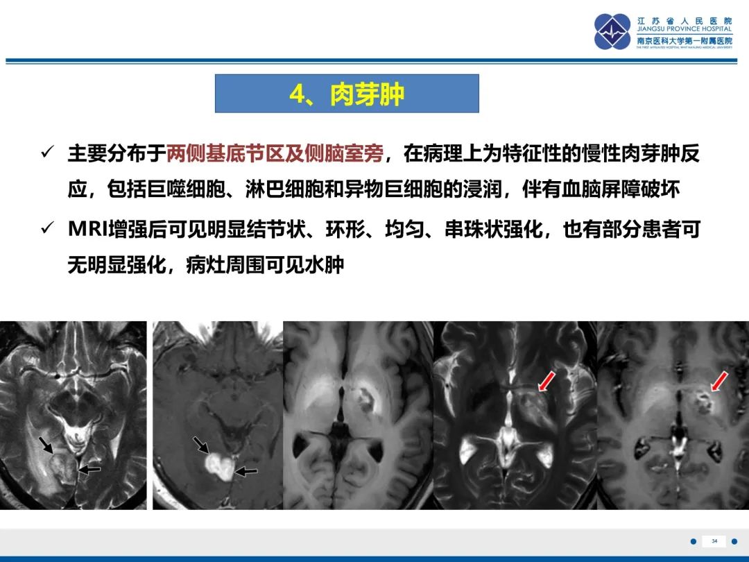 影像PPT - 【PPT】隐球菌脑膜脑炎-35