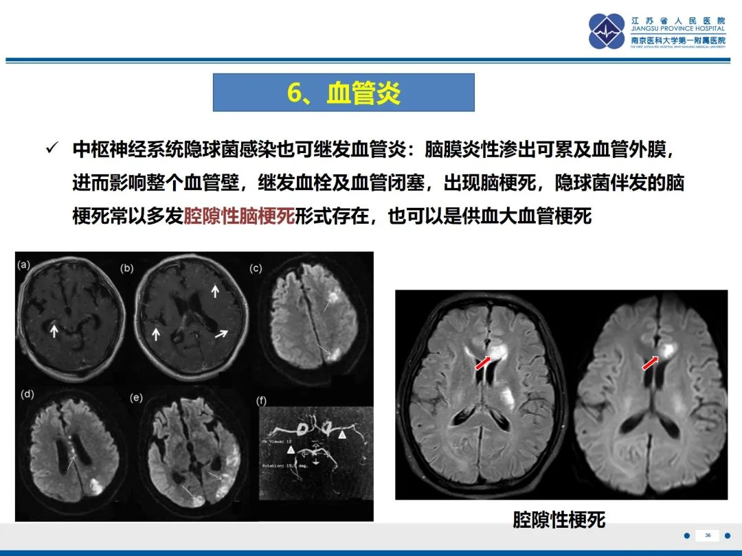 影像PPT - 【PPT】隐球菌脑膜脑炎-37
