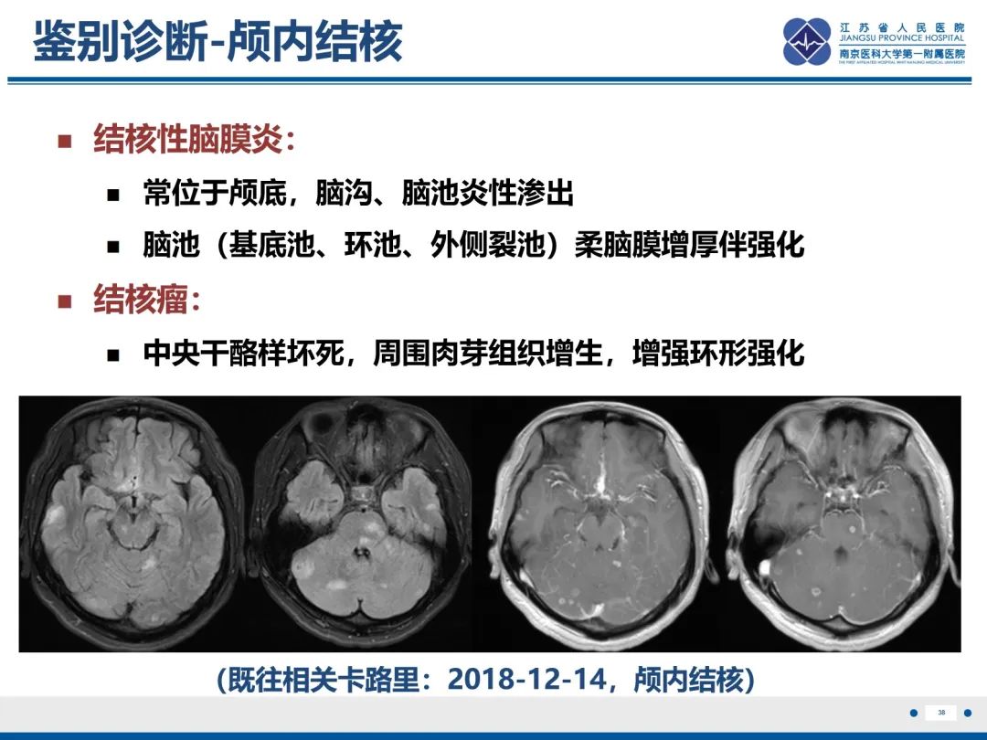 影像PPT - 【PPT】隐球菌脑膜脑炎-39